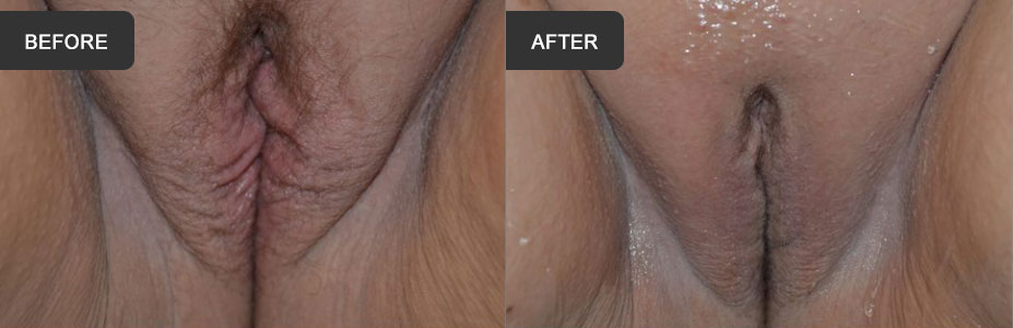 Fractional Erbium Laser For Vaginal Rejuvenation